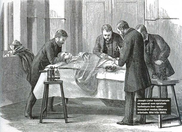 Joseph Lister pulvérisant du phénol sur la blessure pendant que les médecins effectuaient une opération. (Populär historia 2/2015 / Domaine public)