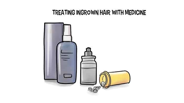 Traiter les cheveux incarnés avec des médicaments