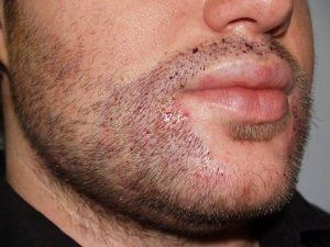 chirurgie de greffe de barbe