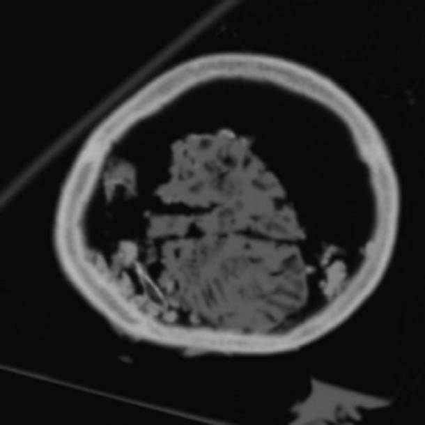Coupe CT du crâne montrant deux des plus gros fragments, qui peuvent être les hémisphères cérébraux séparés par la fente sagittale. (David King)