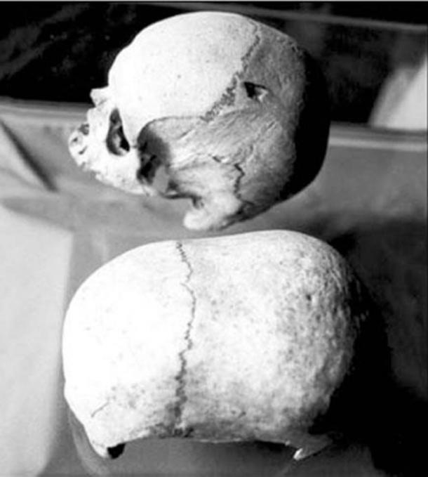 Deux des mystérieux crânes de Malte, dont celui du dolicocéphale (à longue tête) en dessous. (Adriano Forgione)
