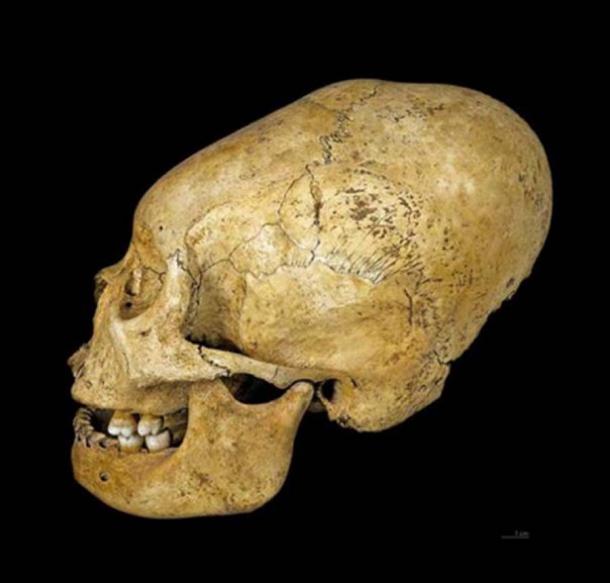 Proto Nazca crâne déformé, vers 200-100 av. (CC BY SA 4.0)