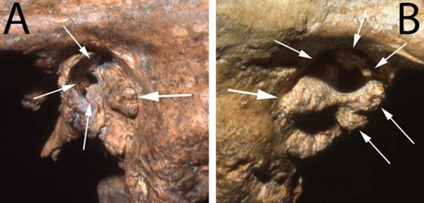 Deux vues du conduit auditif du fossile de Néandertal Shanidar 1 montrant des difformités susceptibles d'avoir causé une surdité profonde. (Image : avec l'aimable autorisation d'Erik Trinkaus)